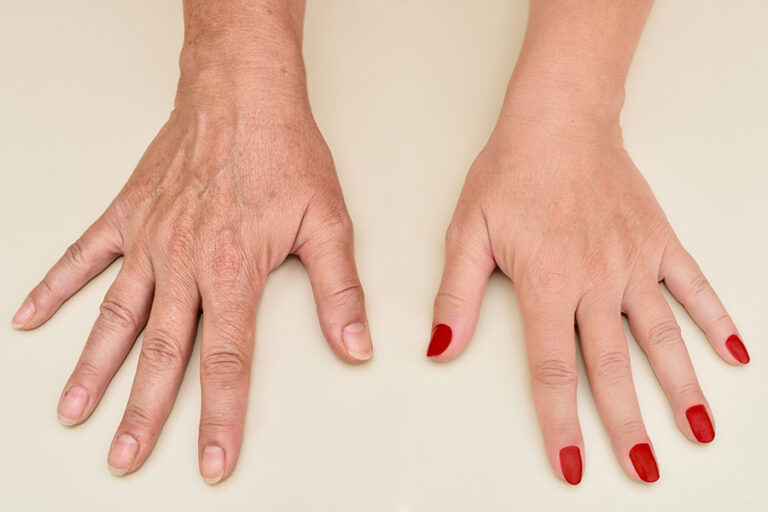 Hands of a woman before and after skin treatment