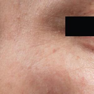 INTRAcel™ Microneedling Before and After Photo by Coachlight Clinic & Spa in West Des Moines Iowa