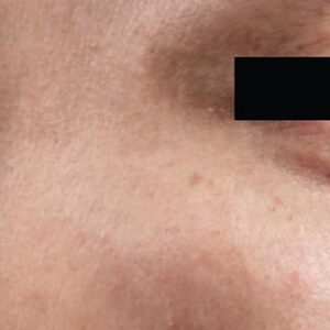 INTRAcel™ Microneedling Before and After Photo by Coachlight Clinic & Spa in West Des Moines Iowa