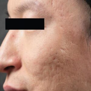 INTRAcel™ Microneedling Before and After Photo by Coachlight Clinic & Spa in West Des Moines Iowa