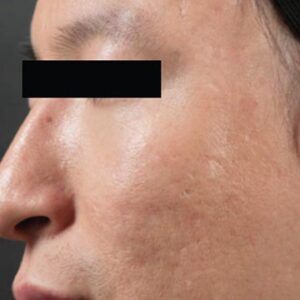 INTRAcel™ Microneedling Before and After Photo by Coachlight Clinic & Spa in West Des Moines Iowa