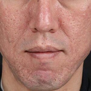 INTRAcel™ Microneedling Before and After Photo by Coachlight Clinic & Spa in West Des Moines Iowa