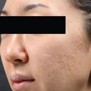 INTRAcel™ Microneedling Before and After Photo by Coachlight Clinic & Spa in West Des Moines Iowa