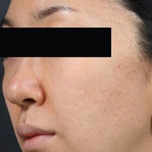 INTRAcel™ Microneedling Before and After Photo by Coachlight Clinic & Spa in West Des Moines Iowa