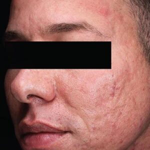 INTRAcel™ Microneedling Before and After Photo by Coachlight Clinic & Spa in West Des Moines Iowa