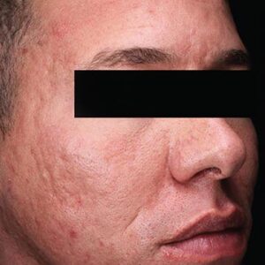 INTRAcel™ Microneedling Before and After Photo by Coachlight Clinic & Spa in West Des Moines Iowa