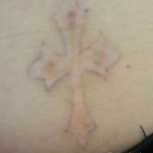 Tattoo Removal Before and After Photo by Coachlight Clinic & Spa in West Des Moines Iowa