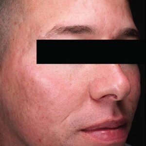 INTRAcel™ Microneedling Before and After Photo by Coachlight Clinic & Spa in West Des Moines Iowa