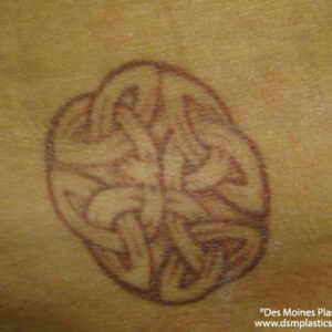 Tattoo Removal Before and After Photo by Coachlight Clinic & Spa in West Des Moines Iowa
