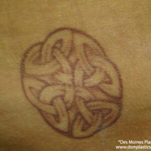 Tattoo Removal Before and After Photo by Coachlight Clinic & Spa in West Des Moines Iowa