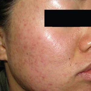 INTRAcel™ Microneedling Before and After Photo by Coachlight Clinic & Spa in West Des Moines Iowa