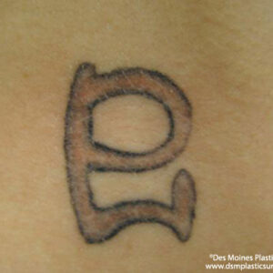 Tattoo Removal Before and After Photo by Coachlight Clinic & Spa in West Des Moines Iowa