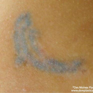 Tattoo Removal Before and After Photo by Coachlight Clinic & Spa in West Des Moines Iowa