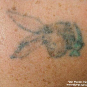 Tattoo Removal Before and After Photo by Coachlight Clinic & Spa in West Des Moines Iowa