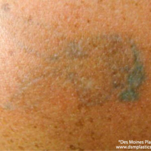 Tattoo Removal Before and After Photo by Coachlight Clinic & Spa in West Des Moines Iowa