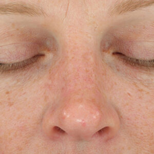 DiamondGlow Before and After Photo by Coachlight Clinic & Spa in West Des Moines Iowa
