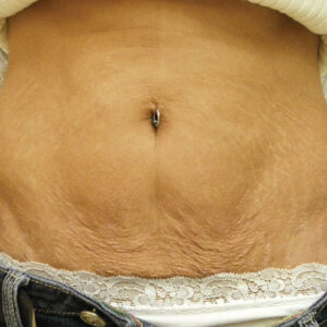 SkinTyte Before and After Photo by Coachlight Clinic & Spa in West Des Moines Iowa