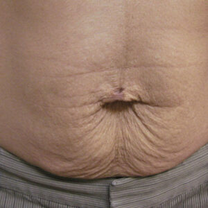 SkinTyte Before and After Photo by Coachlight Clinic & Spa in West Des Moines Iowa