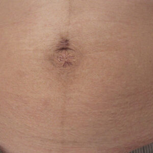 SkinTyte Before and After Photo by Coachlight Clinic & Spa in West Des Moines Iowa