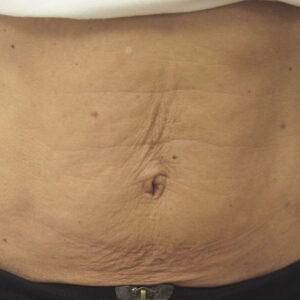 SkinTyte Before and After Photo by Coachlight Clinic & Spa in West Des Moines Iowa