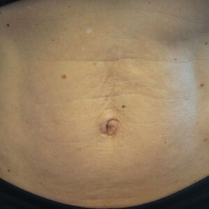 SkinTyte Before and After Photo by Coachlight Clinic & Spa in West Des Moines Iowa