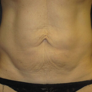 SkinTyte Before and After Photo by Coachlight Clinic & Spa in West Des Moines Iowa