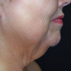 SkinTyte Before and After Photo by Coachlight Clinic & Spa in West Des Moines Iowa