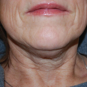 SkinTyte Before and After Photo by Coachlight Clinic & Spa in West Des Moines Iowa