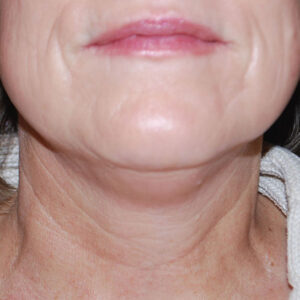 SkinTyte Before and After Photo by Coachlight Clinic & Spa in West Des Moines Iowa