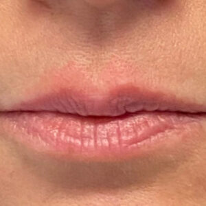 Lip Filler Before and After Photo by Coachlight Clinic & Spa in West Des Moines Iowa