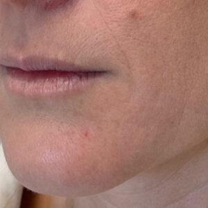 Lip Filler Before and After Photo by Coachlight Clinic & Spa in West Des Moines Iowa