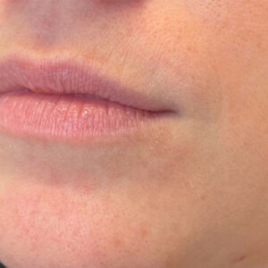 Lip Filler Before and After Photo by Coachlight Clinic & Spa in West Des Moines Iowa