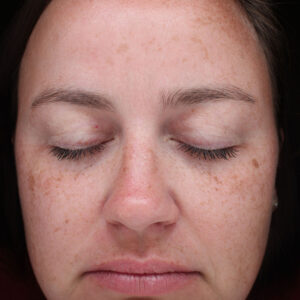 Halo treatment Before and After Photo by Coachlight Clinic Spa in West Des Moines Iowa