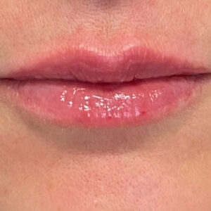 Lip Filler Before and After Photo by Coachlight Clinic & Spa in West Des Moines Iowa