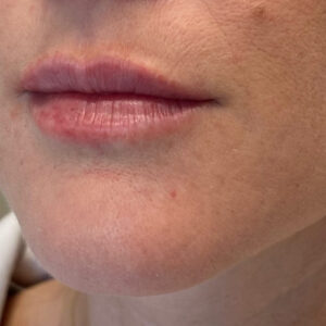 Lip Filler Before and After Photo by Coachlight Clinic & Spa in West Des Moines Iowa