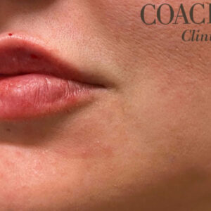 Lip Filler Before and After Photo by Coachlight Clinic & Spa in West Des Moines Iowa