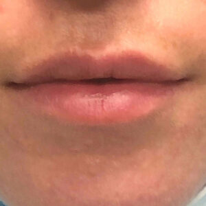 Lip Filler Before and After Photo by Coachlight Clinic & Spa in West Des Moines Iowa