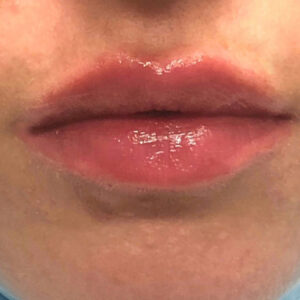 Lip Filler Before and After Photo by Coachlight Clinic & Spa in West Des Moines Iowa