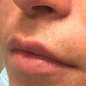 Lip Filler Before and After Photo by Coachlight Clinic & Spa in West Des Moines Iowa