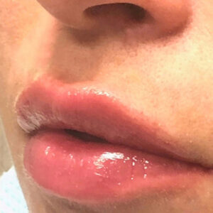 Lip Filler Before and After Photo by Coachlight Clinic & Spa in West Des Moines Iowa