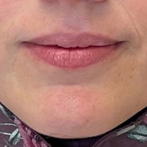 Lip Filler Before and After Photo by Coachlight Clinic & Spa in West Des Moines Iowa