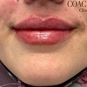 Lip Filler Before and After Photo by Coachlight Clinic & Spa in West Des Moines Iowa