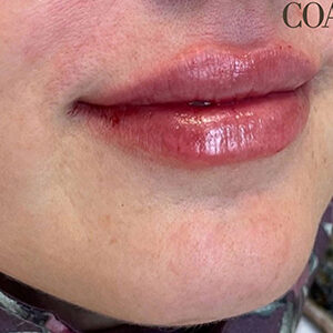 Lip Filler Before and After Photo by Coachlight Clinic & Spa in West Des Moines Iowa