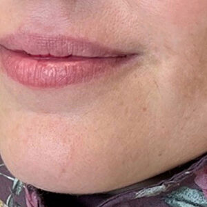 Lip Filler Before and After Photo by Coachlight Clinic & Spa in West Des Moines Iowa