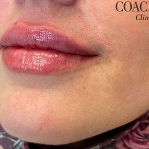 Lip Filler Before and After Photo by Coachlight Clinic & Spa in West Des Moines Iowa