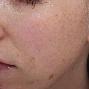 MOXI Before and After Photo by Coachlight Clinic & Spa in West Des Moines Iowa