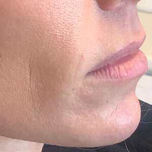 Lip Filler Before and After Photo by Coachlight Clinic & Spa in West Des Moines Iowa