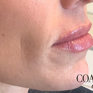 Lip Filler Before and After Photo by Coachlight Clinic & Spa in West Des Moines Iowa