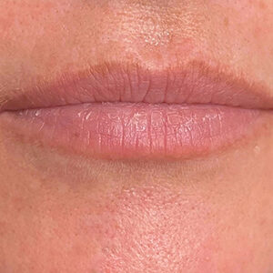 Lip Filler Before and After Photo by Coachlight Clinic & Spa in West Des Moines Iowa