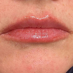 Lip Filler Before and After Photo by Coachlight Clinic & Spa in West Des Moines Iowa